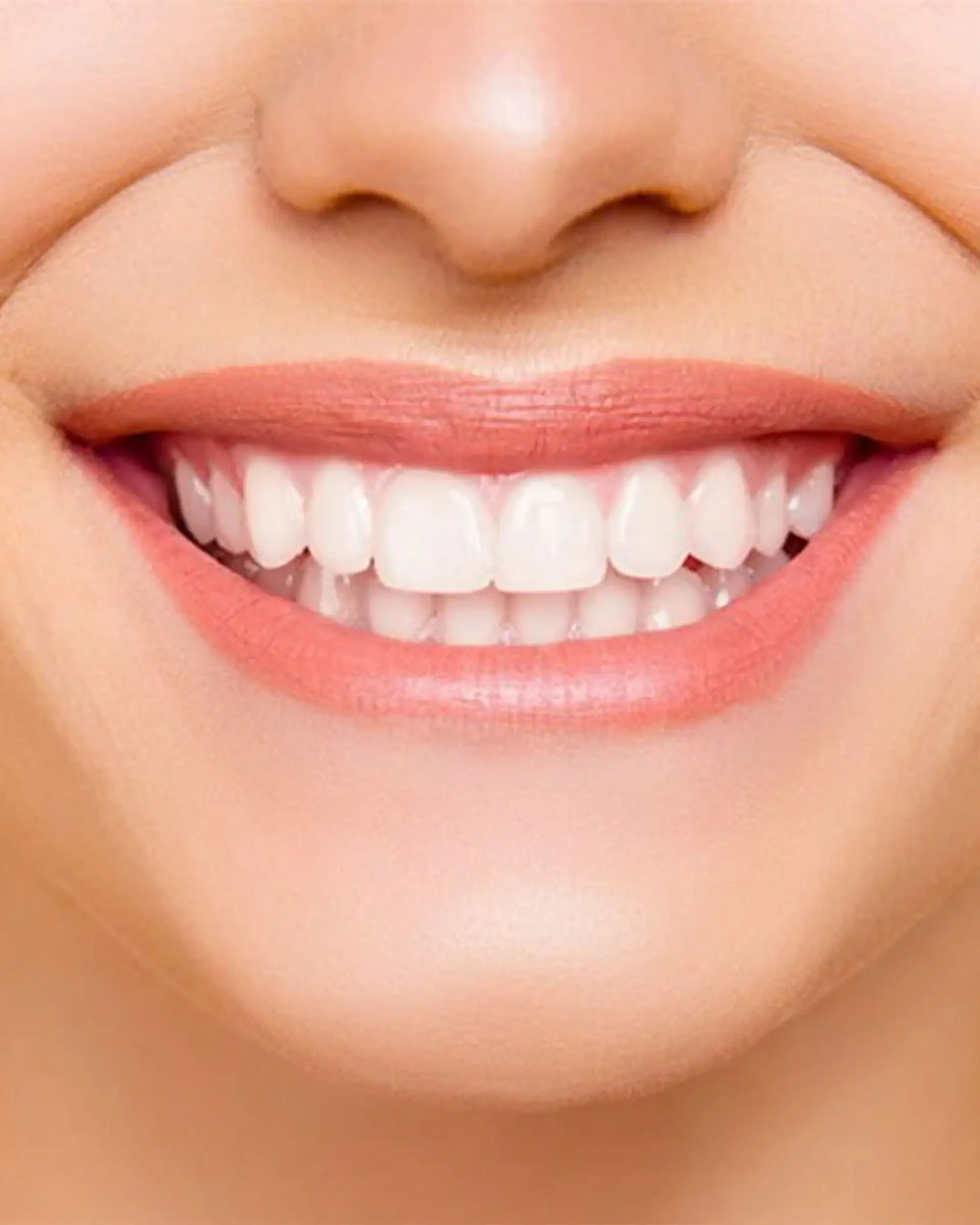 procedure-hollywood-smile