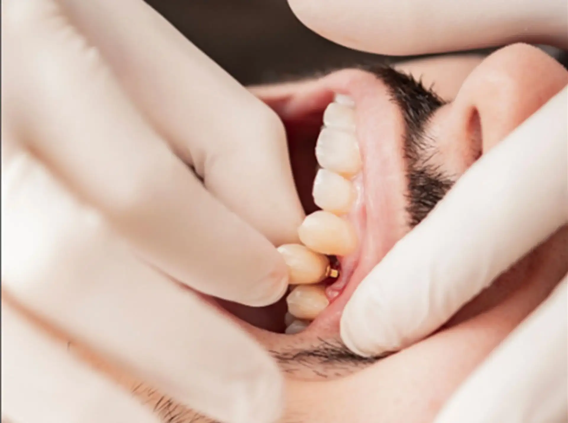 the-dental-implant