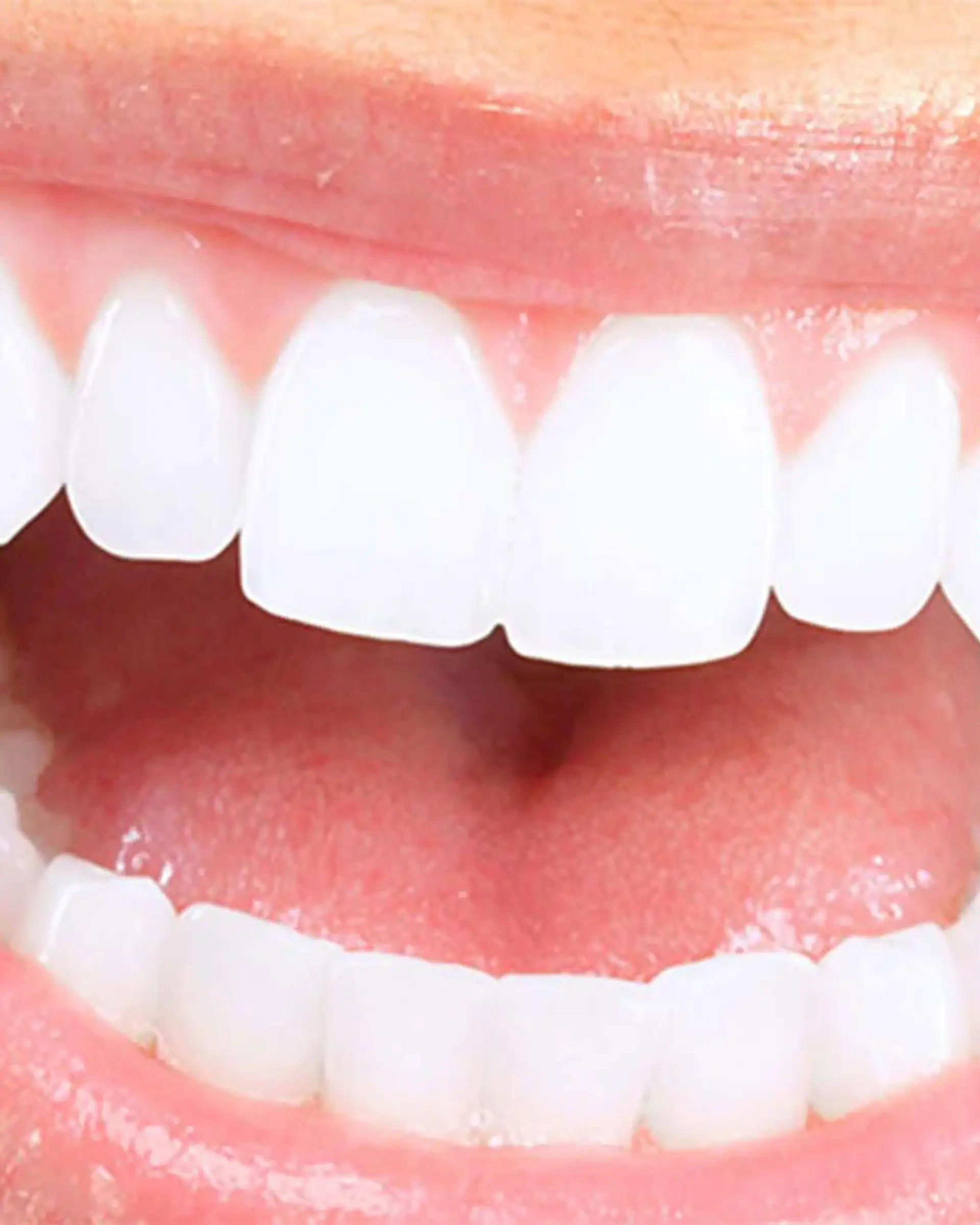 maintaining-your-hollywood-smile