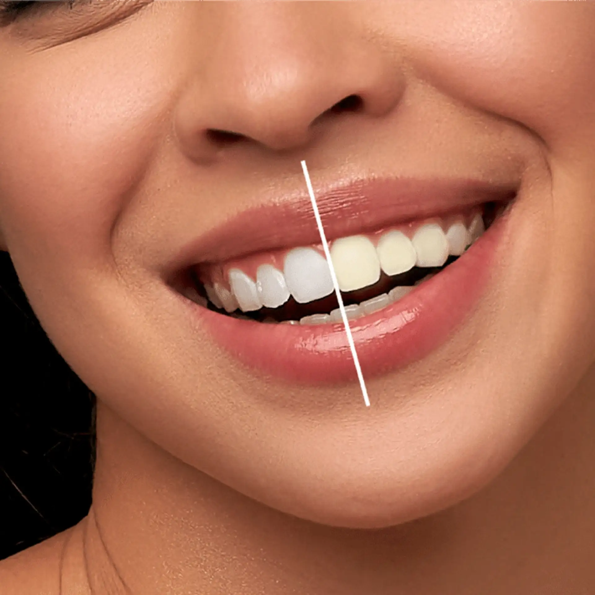 what-is-teeth-whitening