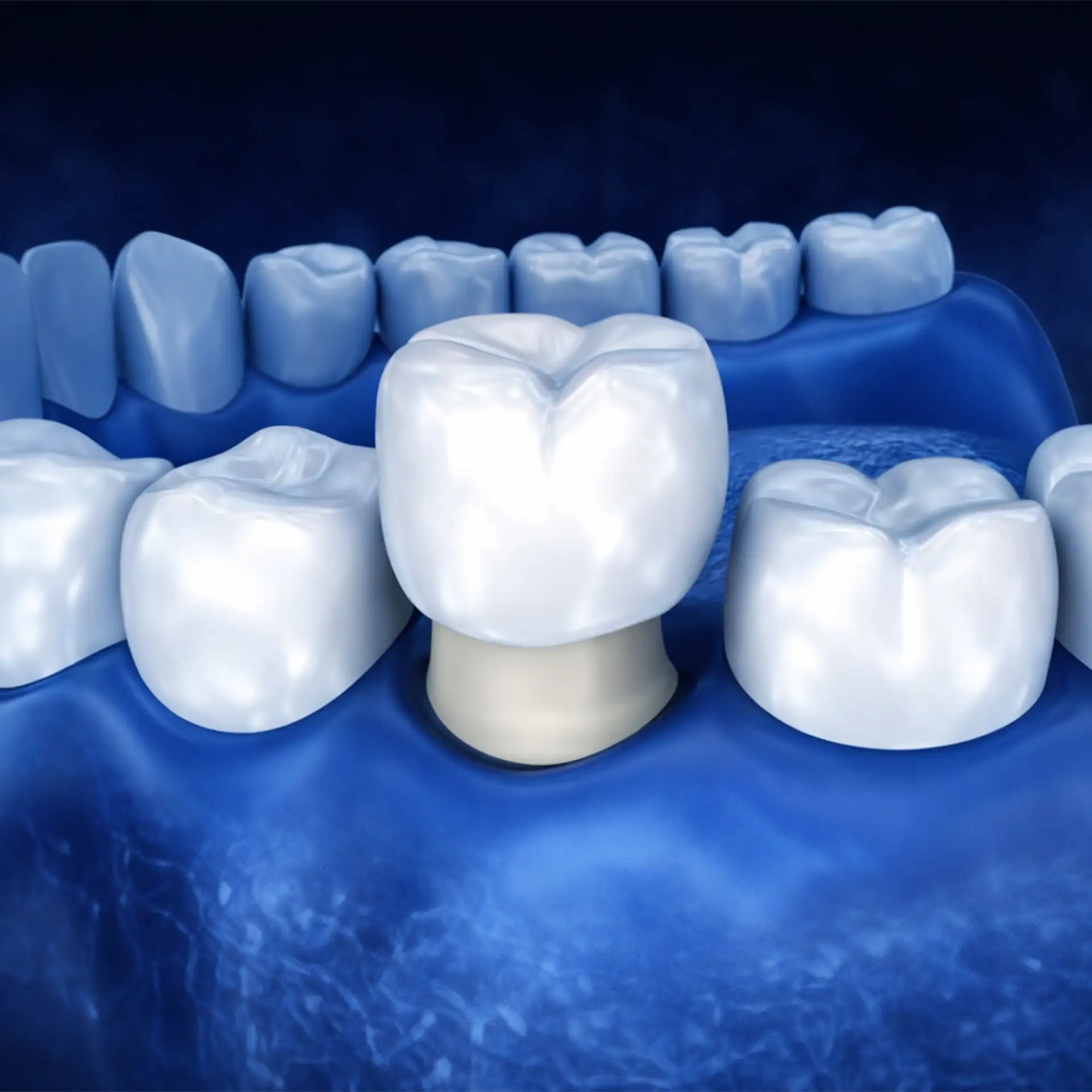 what-are-dental-zirconium-crowns