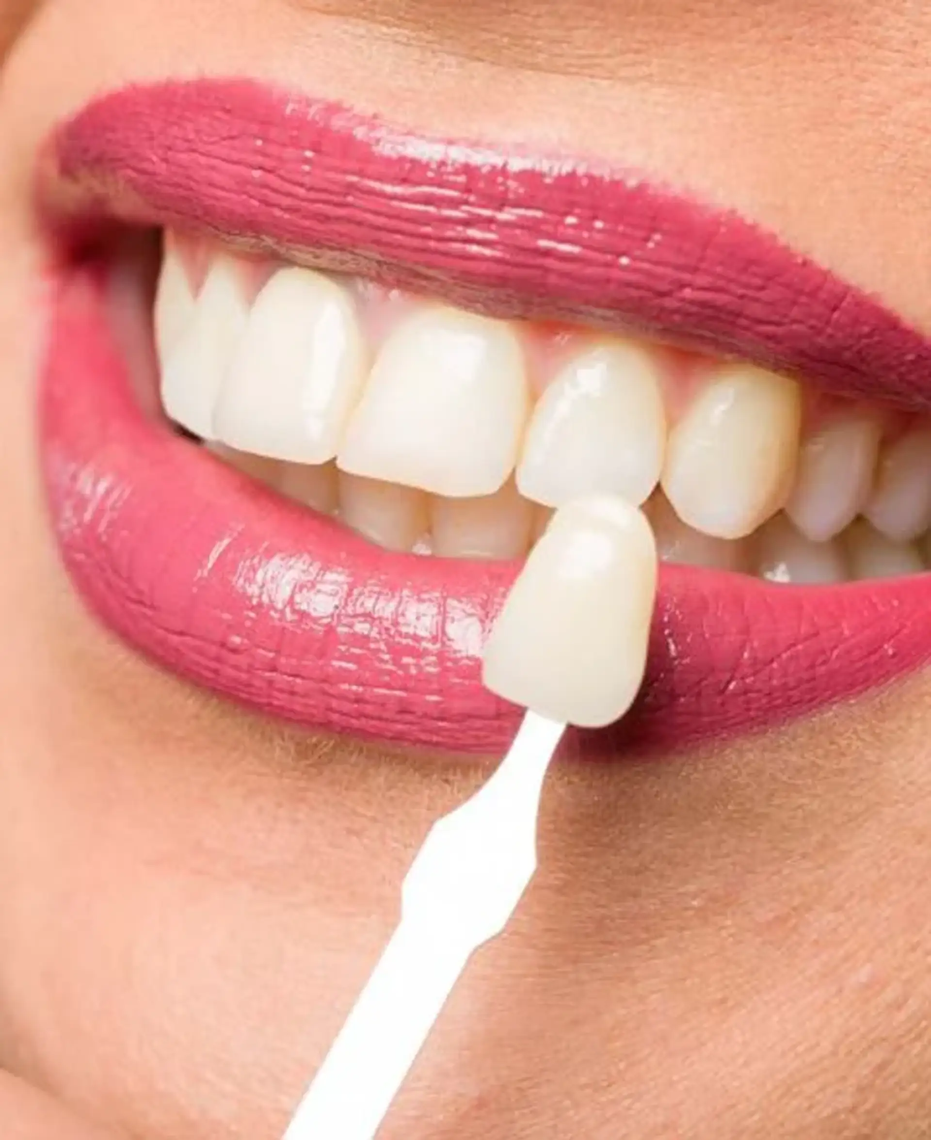 advantages-and-disadvantages-of-e-max-veneers