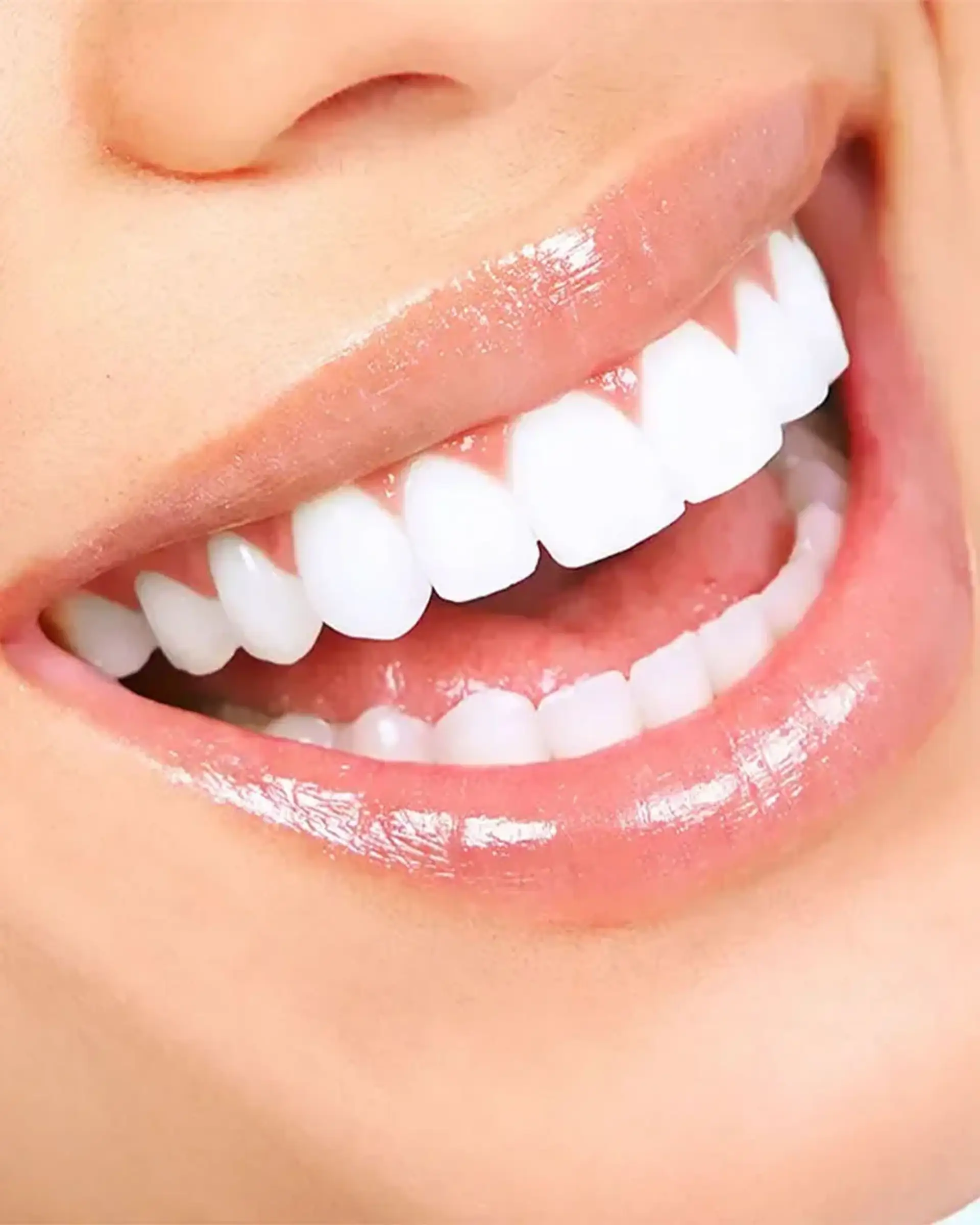 veneer-treatment-process