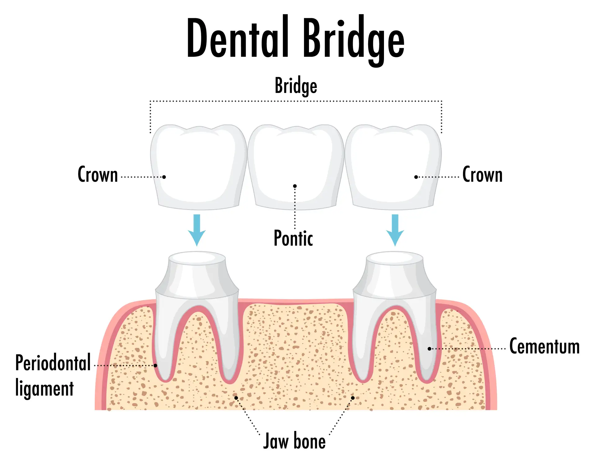 what-is-bridge