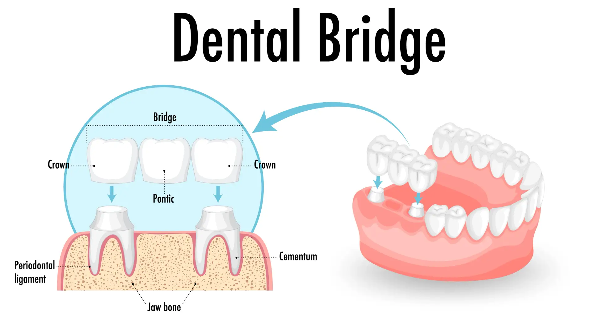dental-bridges-in-istanbul