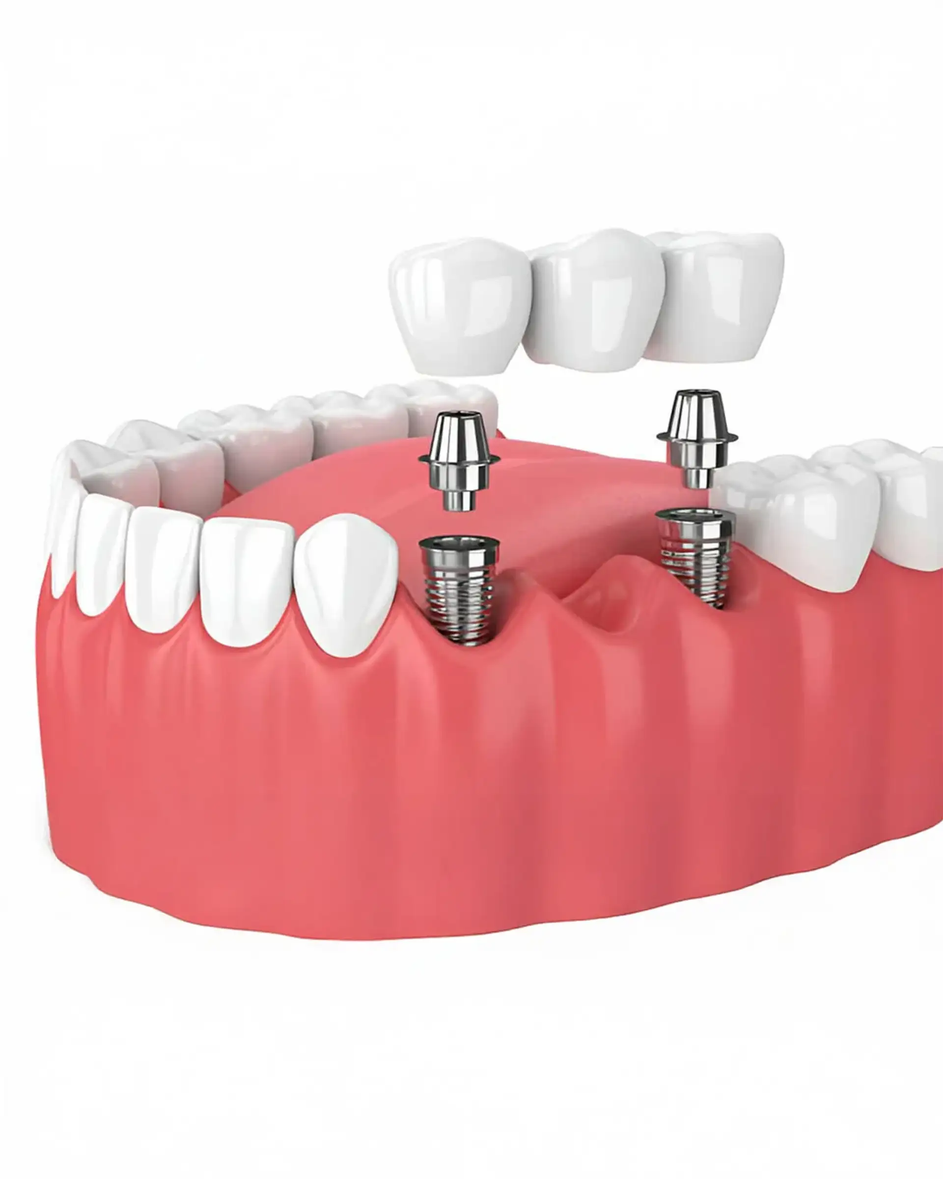 why-choose-dental-implants