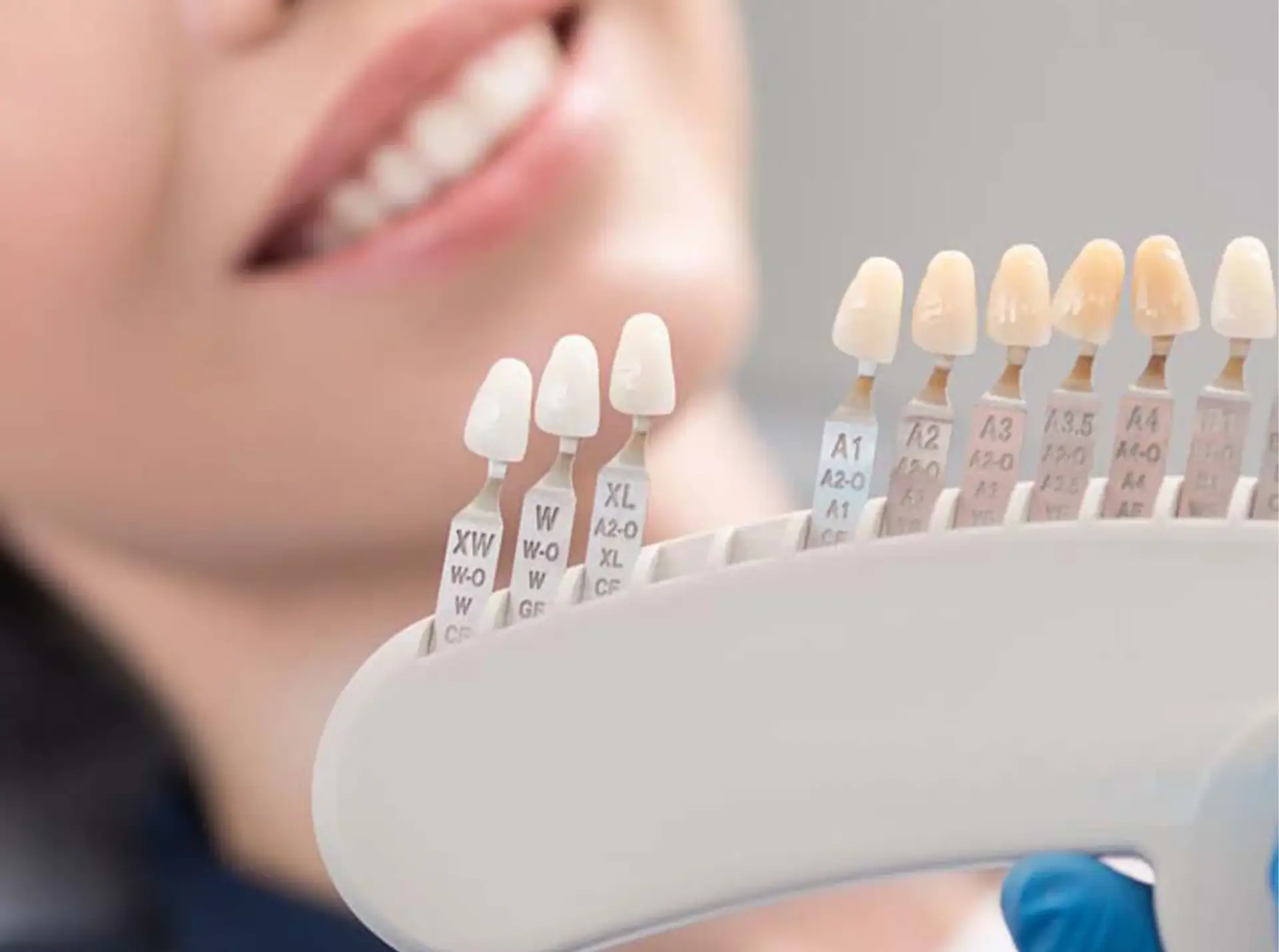 preparation-veneer-treatment