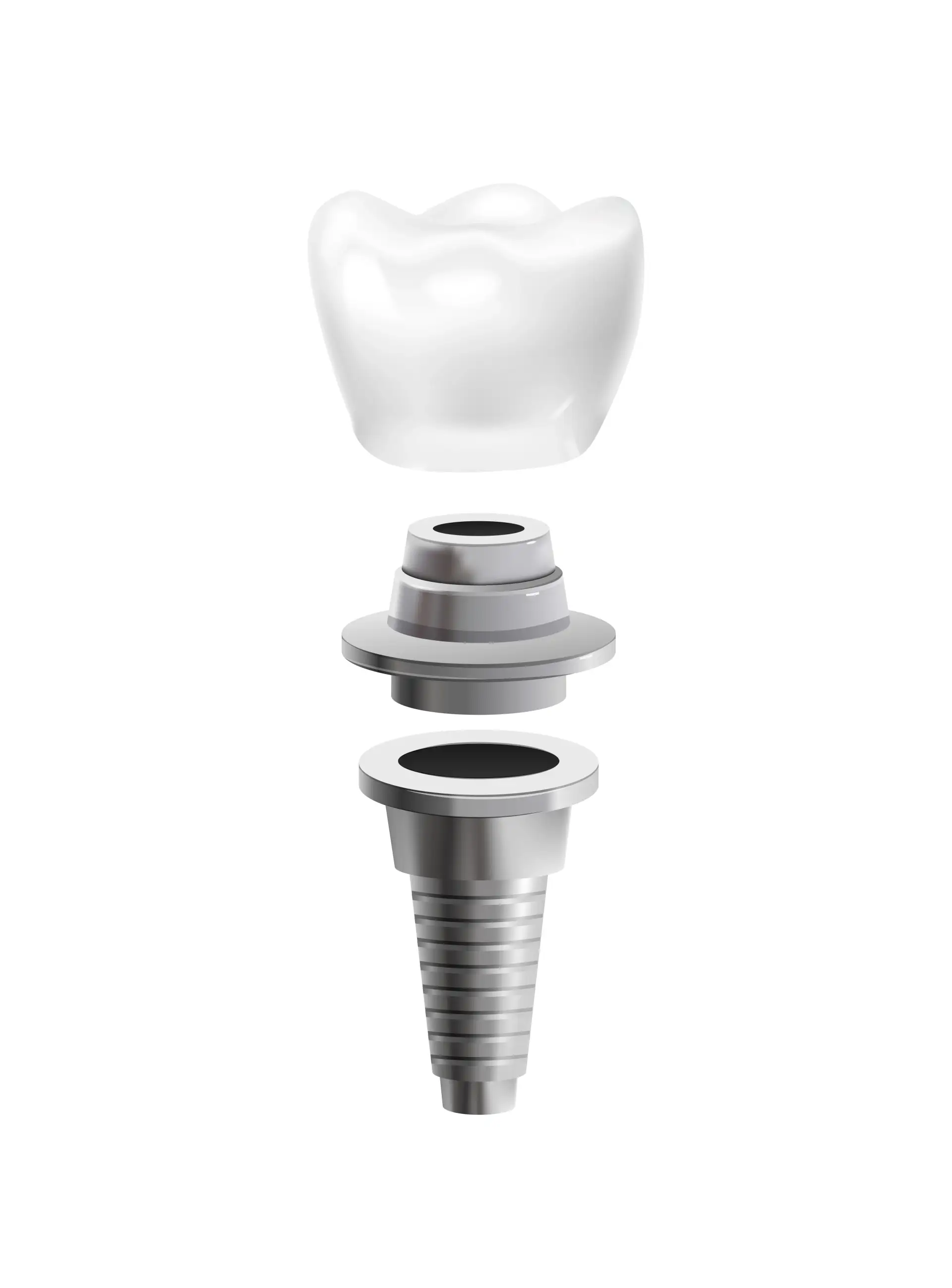 all-on-x-dental-implants-comparison