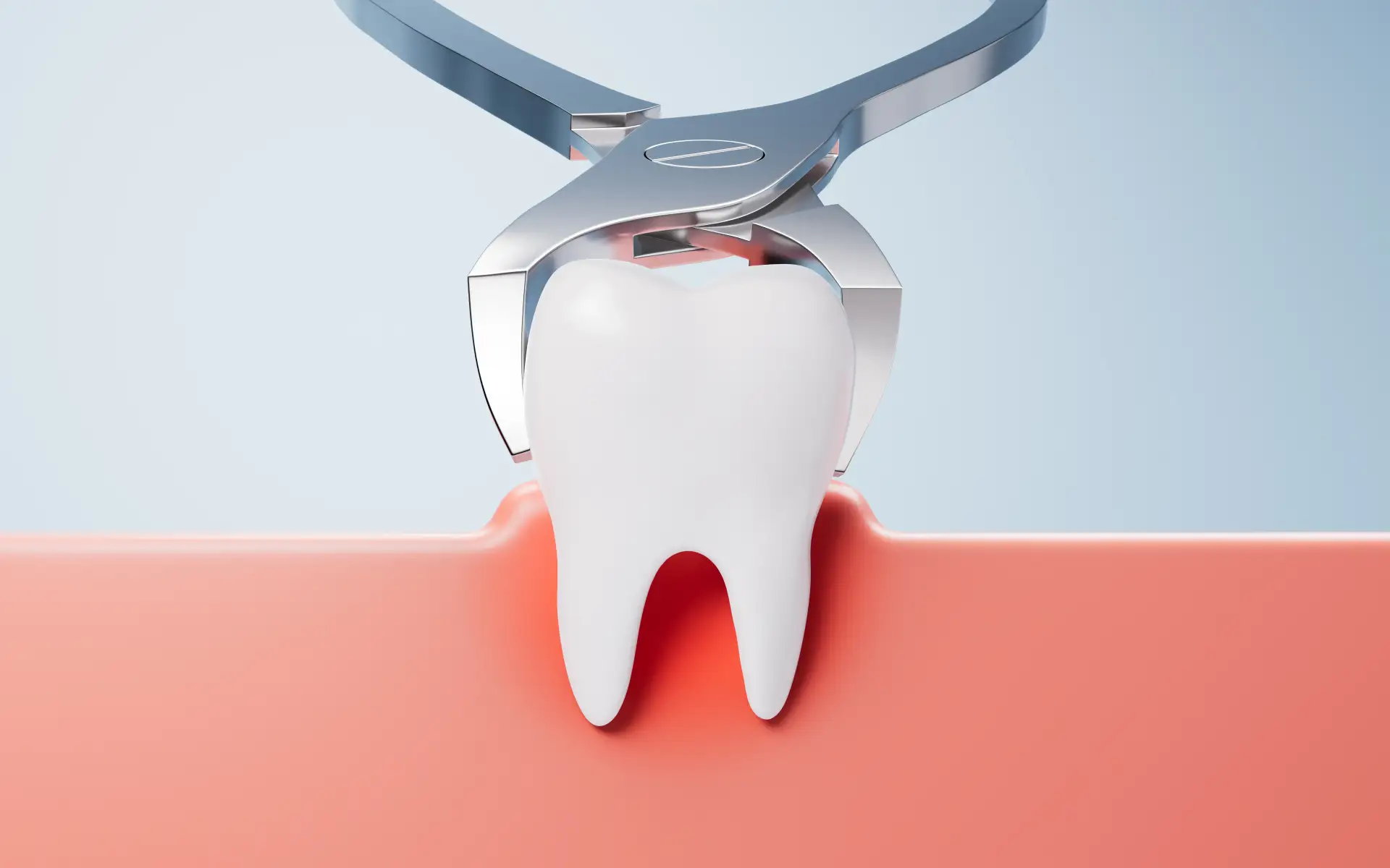 wisdom-tooth-removal