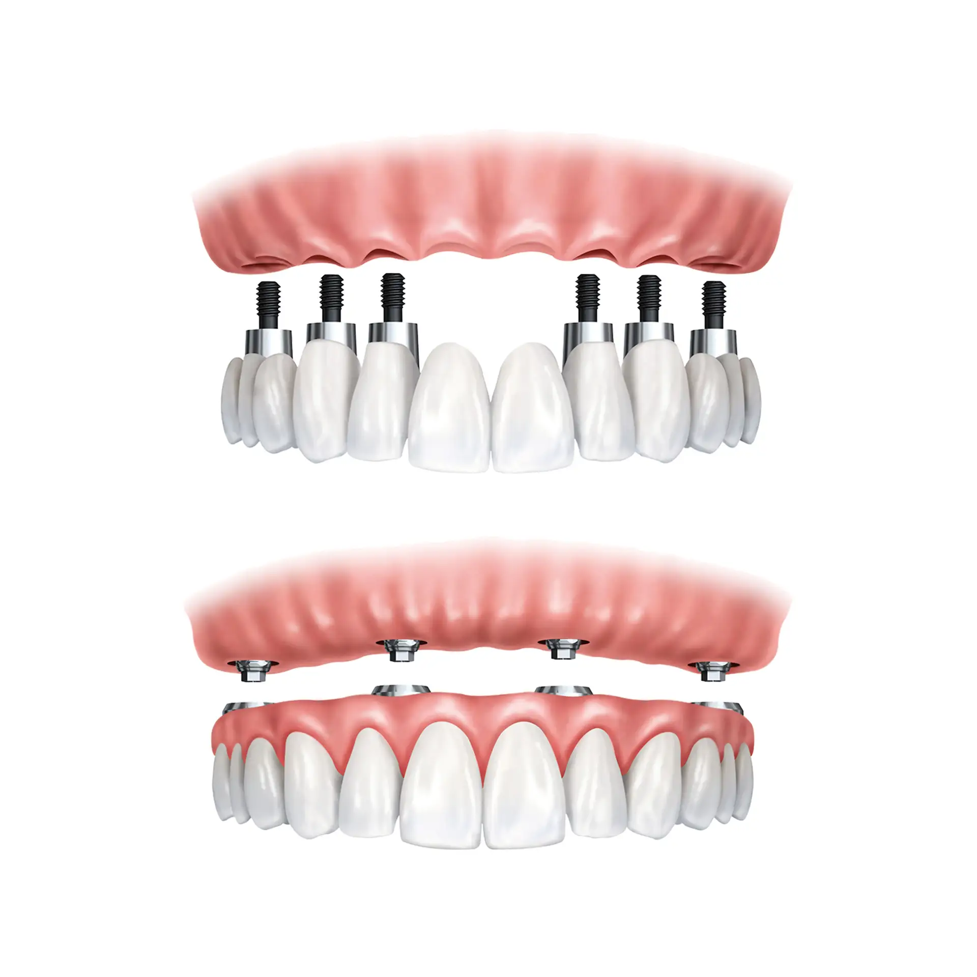 all-on-8-dental-implants