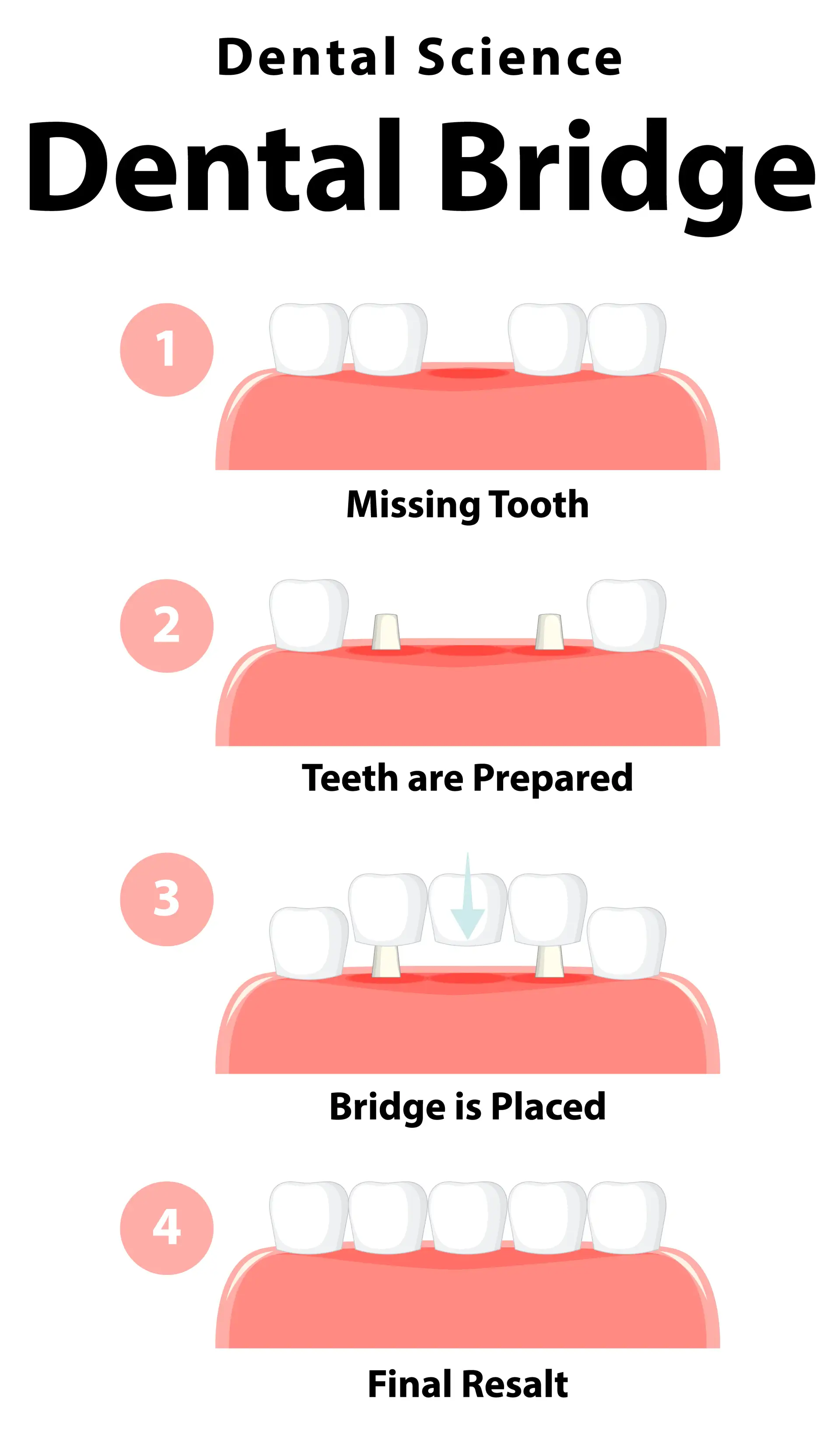 how-is-bridge-fitted