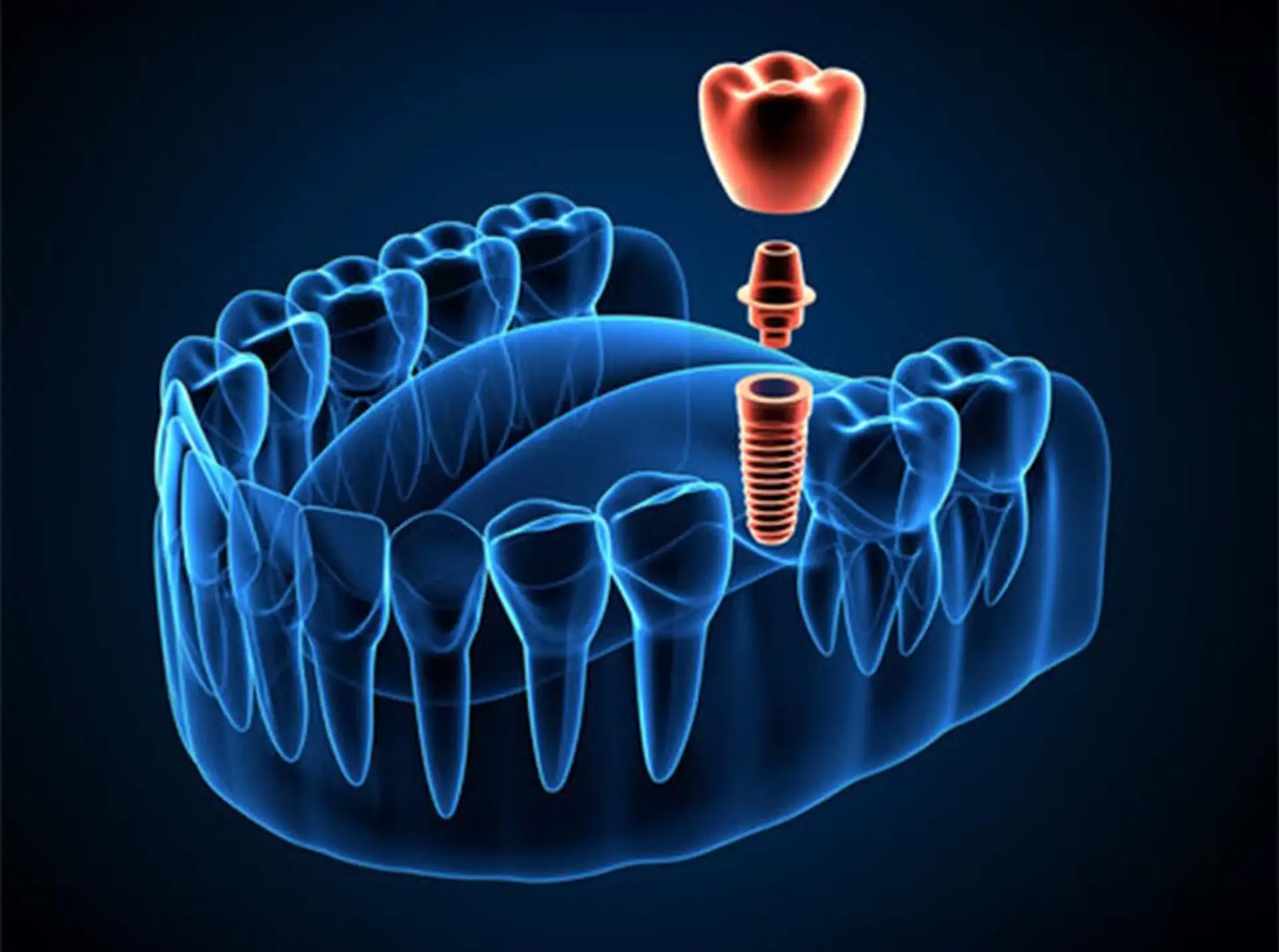 the-all-on-x-implant