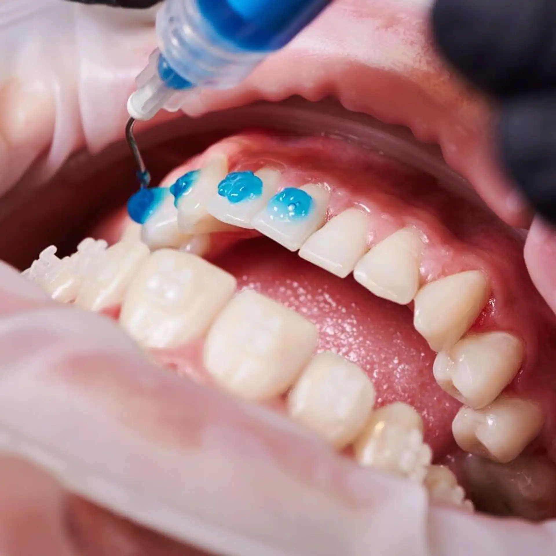 how-long-does-teeth-whitening