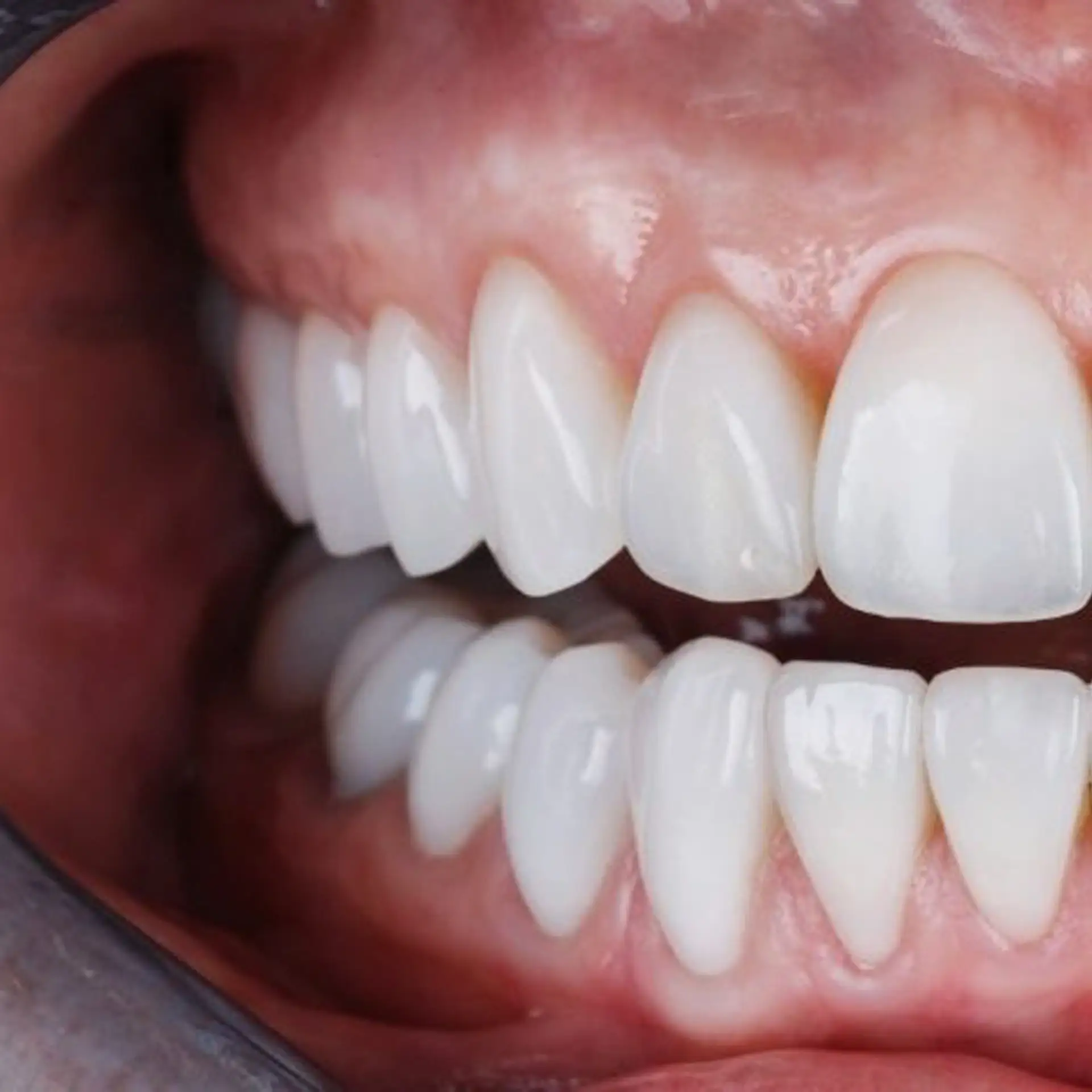 how-long-will-zirconia-crown